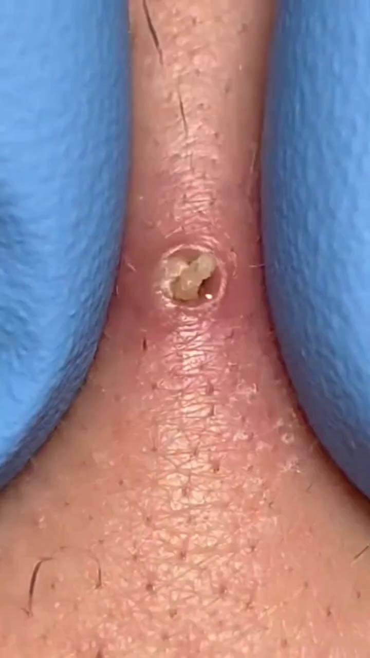 Prompt: Ultra close macro shot focused on a single dilated pore of winer. Camera remains locked. Clinical neutral lighting. Only gloved fingers visible performing a slow controlled extraction. First moments show no reaction. Pressure builds gradually. The release is delayed until the final third. Skin remains realistic and calm throughout. Final frame holds on settled skin for looping.