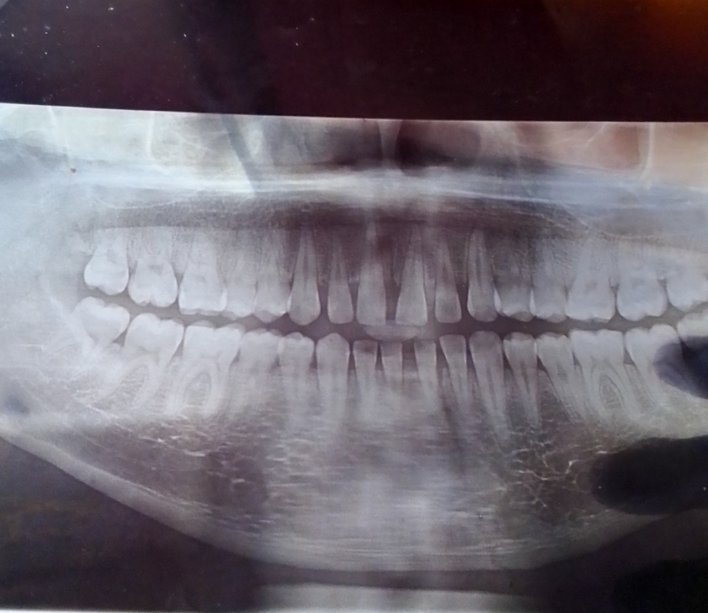 Prompt: ALi Boubacar's Skeleton teeth his self in 2020